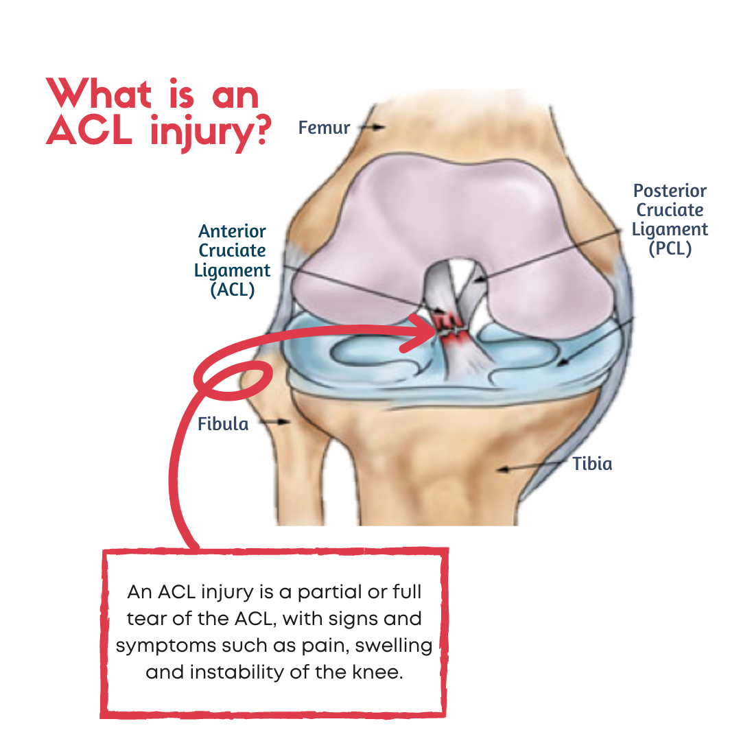 ACL Injury Prevention